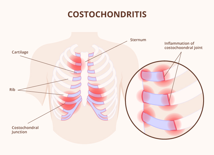 Costochondritis In Women